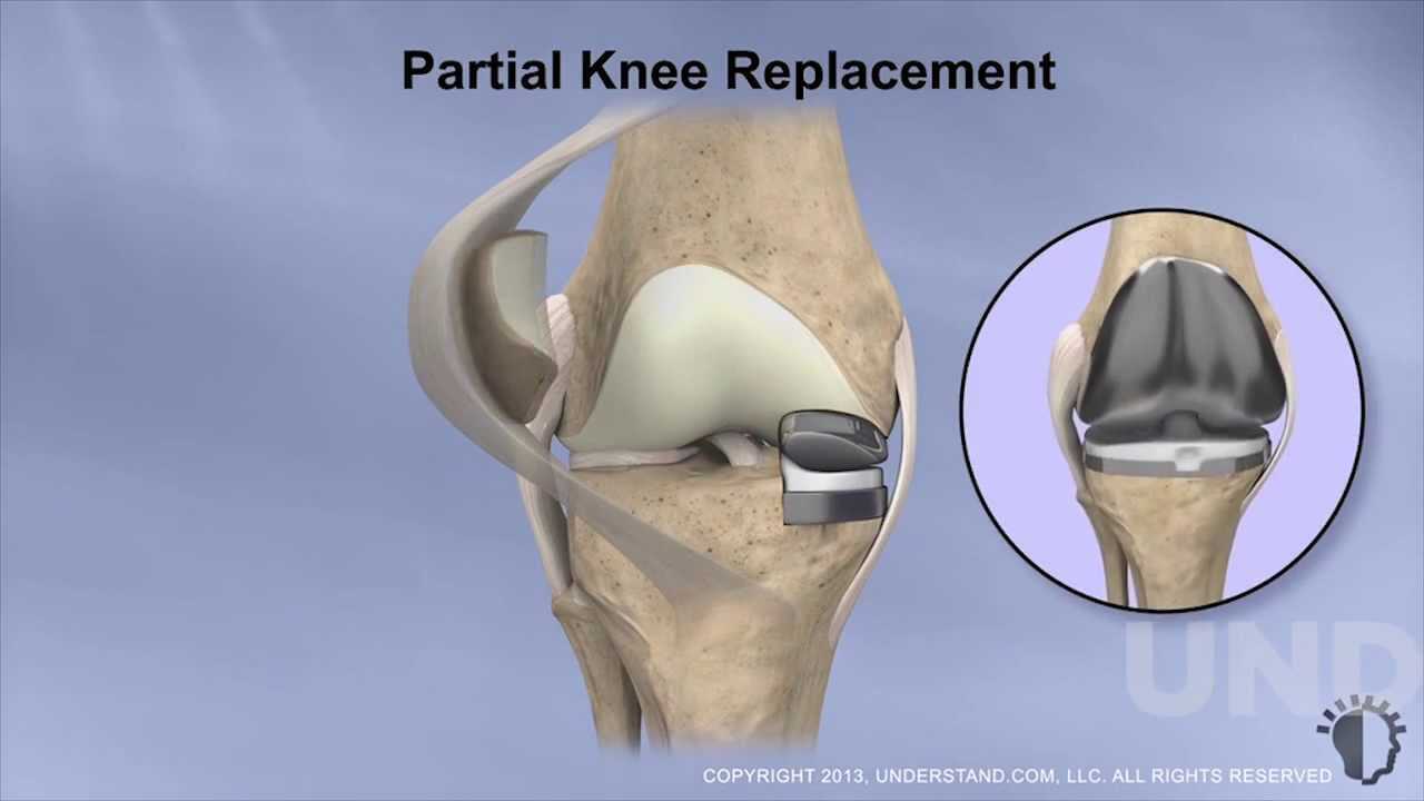 partial knee replacement